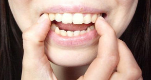 Răng hơi hô có nên niềng không?