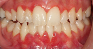 Cách chữa bệnh viêm nướu răng an toàn hiệu quả nhất hiện nay