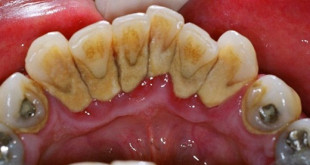 Lấy cao răng có đau không và ảnh hưởng gì đến răng? ></noscript>> BS tư vấn