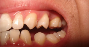 Niềng răng có khắc phục được răng thưa không? – BS nha khoa