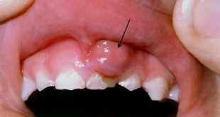 Viêm nướu răng ở trẻ em có đơn giản như bạn nghĩ?