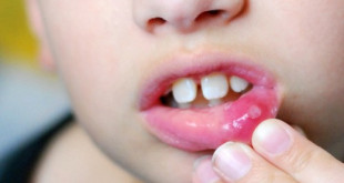 Bệnh lở miệng kéo dài bao lâu?