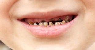 6 nguyên nhân sâu răng nguy hiểm bạn nên biết