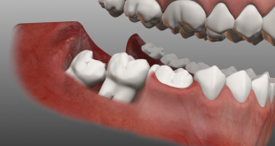 Mọc răng khôn đau bao lâu? – Tư vấn từ chuyên gia răng hàm mặt