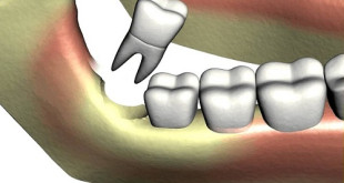 Nhổ răng khôn bị sâu với phương pháp nhổ răng an toàn