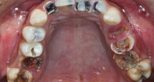 Những điều cần biết về hàn sâu răng
