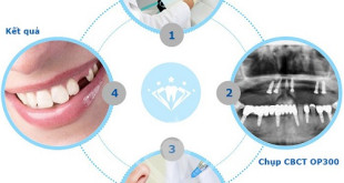 Quy trình nhổ răng sâu an toàn không hề đau