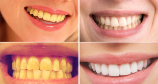 Bật mí răng bị vàng làm sao cho trắng sáng?
