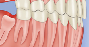 Răng khôn mọc trong bao lâu- Và nhổ răng khôn như thế nào