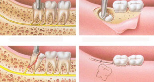 Nhổ răng số 8 có nguy hiểm không, có biến chứng gì không?