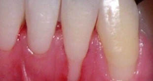 Các cách chữa bệnh viêm nướu răng hiệu quả nhất