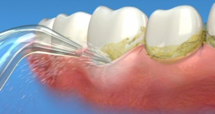 Cao răng là gì và có nên lấy cao răng thường xuyên không