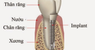 Cắm răng implant: Phương pháp trồng răng hiệu quả vĩnh viễn