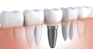 Những trường hợp nào nên cấy răng implant?