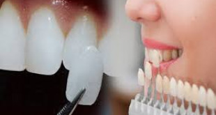 Chỉnh răng thưa bằng bọc sứ là biện pháp nhanh và hiệu quả nhất