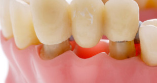 Làm cầu răng có tốt không và có ưu nhược điểm gì?