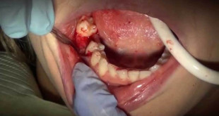 Nhổ răng sâu có ảnh hưởng gì không và quy trình nhổ răng tại nha khoa