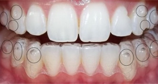 Niềng răng tháo lắp có hiệu quả không? – Kiến thức nha khoa