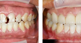 Sâu răng cửa thì phải làm sao – Giải pháp tốt nhất từ chuyên gia