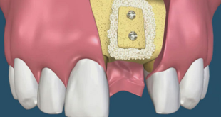 Những lý do vì sao nên ghép xương răng bạn nên biết