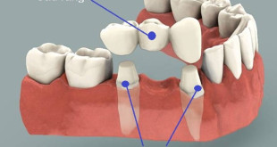 Có nên làm cầu răng không khi bị mất răng hàm ?
