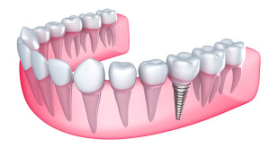 Mất 1 răng có thể trồng răng bằng cách nào tối ưu nhất?