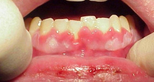 Nguyên nhân và cách trị bệnh viêm nướu răng