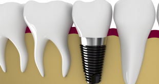 Cấy ghép răng Implant hay làm cầu răng sứ?