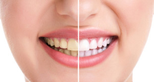 Những yếu tố quyết định có nên tẩy trắng răng không?