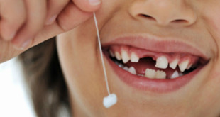 Những câu hỏi xung quanh nhổ răng trẻ em