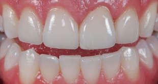 Trồng răng sứ vĩnh viễn có đau không? Tư vấn nha khoa