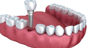 Cấy răng implant những điều cần biết!
