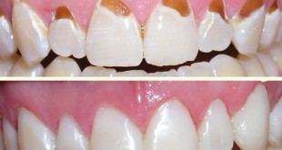 Hàn trám răng thẩm mỹ có ưu điểm gì và quy trình thực hiện ra sao?
