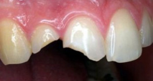 Trám răng có đau không? Trường hợp nào nên trám răng?