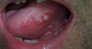 Những điều bạn nên chú ý về bệnh lở miệng ở người lớn và cách chữa trị