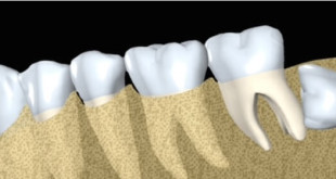 Mọc răng khôn có ý nghĩa gì? – Kiến thức về răng khôn