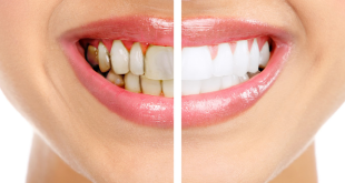 Tẩy trắng răng giá bao nhiêu là hợp lý nhất hiện nay?