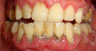 Tìm hiểu về cao răng và sự hình thành cao răng ra sao?