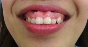 Đặc điểm nhận biết của bệnh hô răng