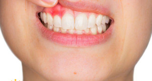 Chăm sóc răng bị viêm lợi – Chữa như thế nào? <<< XEM NGAY