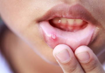 5 Nguyên nhân chính gây bệnh lở miệng mà chắc chắn bạn chưa biết