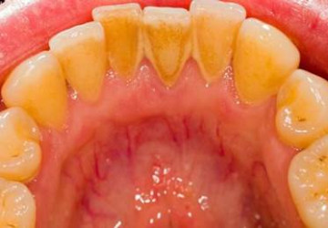 Cao răng màu gì – Những điều thú vị về cao răng bạn cần biết