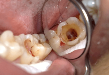 Chữa sâu răng thế nào là hiệu quả nhất hiện nay?