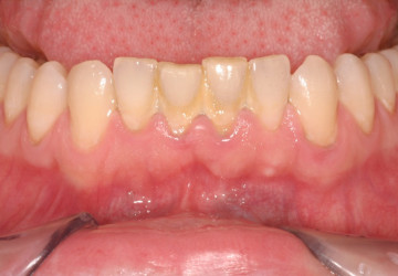 Mảng bám răng và cách phòng mảng bám trên răng