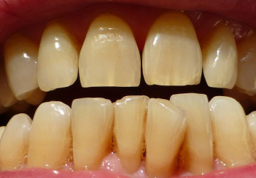 Các nguyên nhân không thể ngờ gây răng bị ố vàng và cách khắc phục