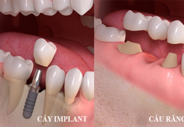 Bạn nên làm cầu răng hay Implant để có hiệu quả làm đẹp cao nhất