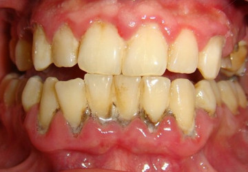 Tìm hiểu về cao răng và sự hình thành cao răng ra sao?