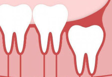 Cách chăm sóc răng khôn khi bạn muốn giữ chúng lại trên cung hàm