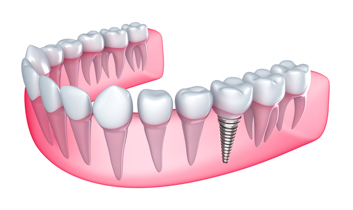 cay-ghep-rang-implant-phuc-hinh-rang-moi-y-nhu-that6