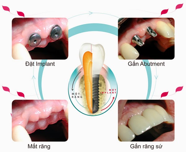 implant123